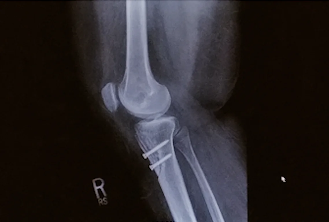 An-X-ray-of-a-Fictors-reconstructive-knee-surgery-accomplished-with-titanium-alloy-screws - Fictiv An X-ray of a Fictor’s reconstructive knee surgery, accomplished with titanium alloy screws.png