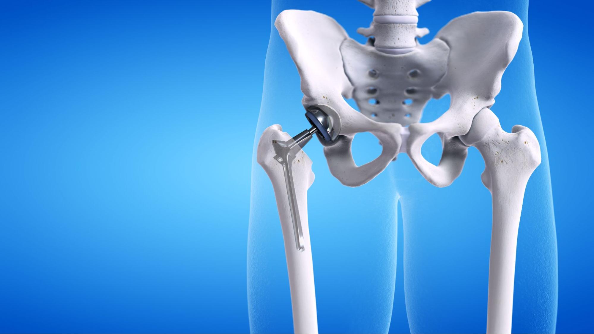 An investment-cast titanium hip implant