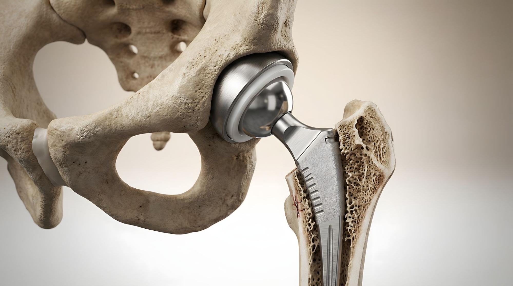Prosthetic hip joint highlighting metal and plastic materials.